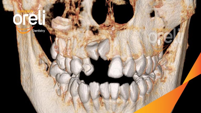 Niềng kéo hai răng ngầm kết quả sau hơn hai năm tại nha khoa Oreli