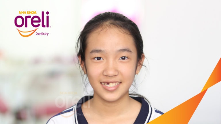 Niềng kéo hai răng ngầm kết quả sau hơn hai năm tại nha khoa Oreli