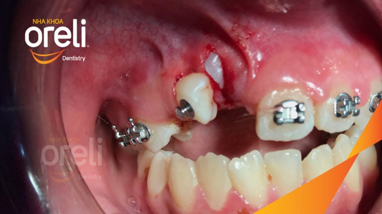 Niềng kéo hai răng ngầm kết quả sau hơn hai năm tại nha khoa Oreli