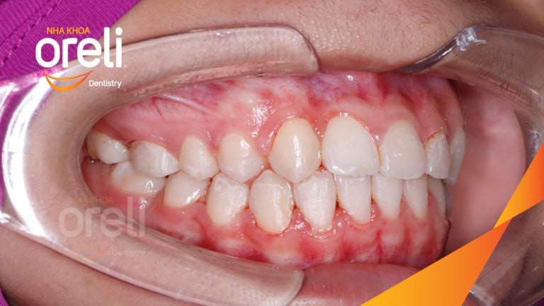 Niềng kéo hai răng ngầm kết quả sau hơn hai năm tại nha khoa Oreli