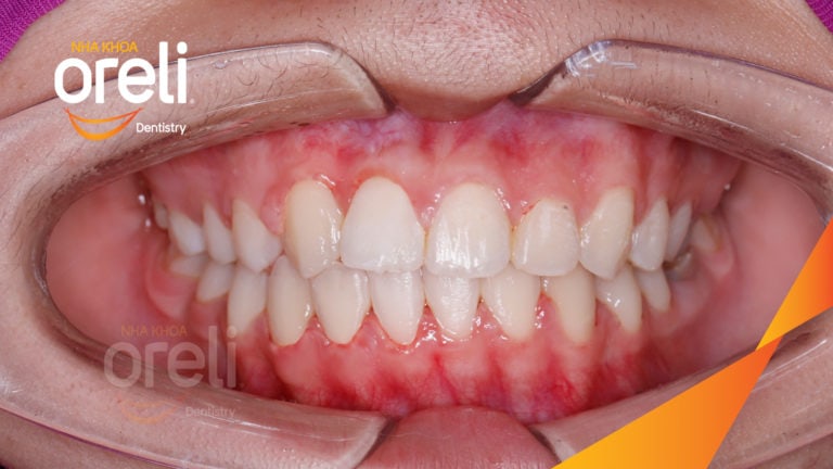 Niềng kéo hai răng ngầm kết quả sau hơn hai năm tại nha khoa Oreli