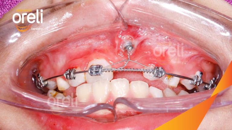 Niềng kéo răng cửa ngầm lạc chỗ kết quá thực tế tại nha khoa Oreli
