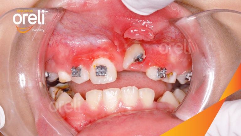 Niềng kéo răng cửa ngầm lạc chỗ kết quá thực tế tại nha khoa Oreli