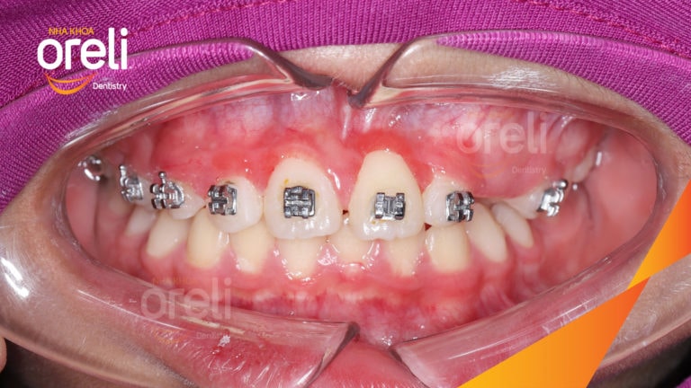 Niềng kéo răng cửa ngầm lạc chỗ kết quá thực tế tại nha khoa Oreli