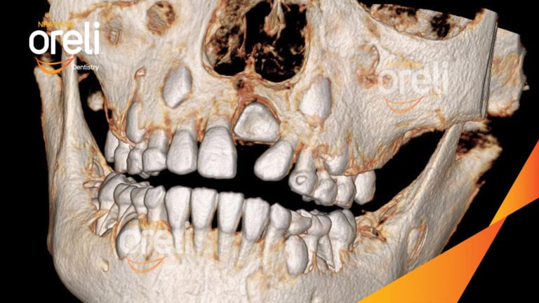 Niềng kéo răng cửa ngầm lạc chỗ kết quá thực tế tại nha khoa Oreli