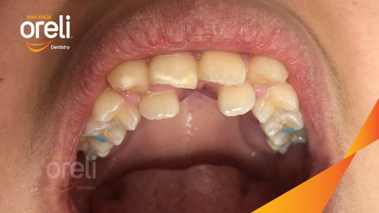 Ca niềng răng chen chúc hoán đổi vị trí trang cửa và răng nanh tại Oreli