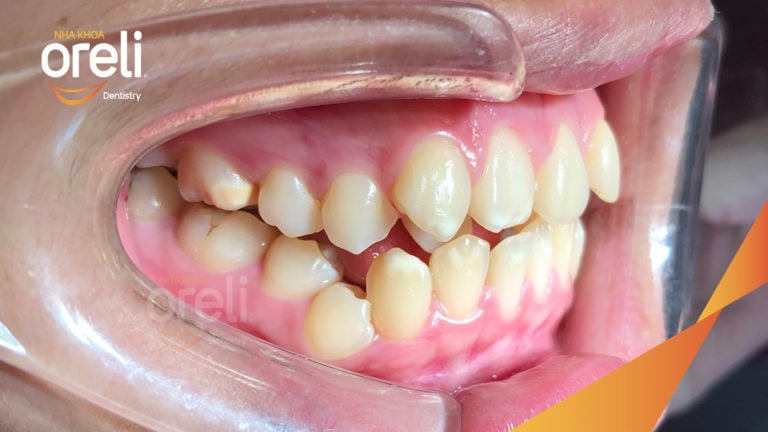 Ca niềng răng chen chúc hoán đổi vị trí trang cửa và răng nanh tại Oreli