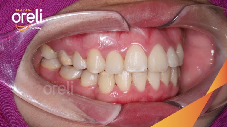 Ca niềng răng chen chúc hoán đổi vị trí trang cửa và răng nanh tại Oreli
