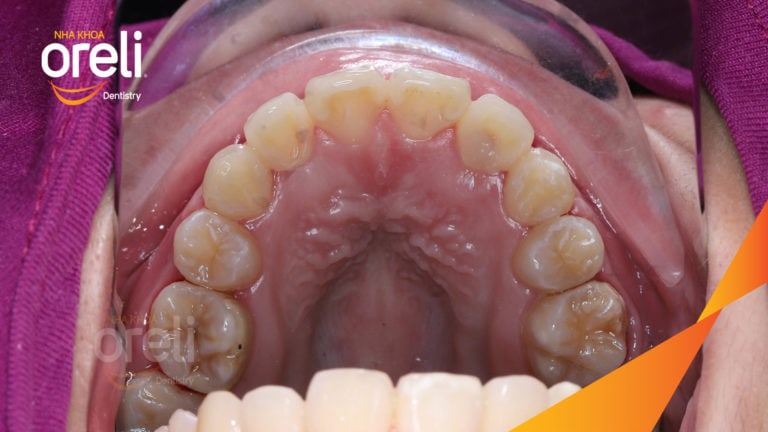 Ca niềng răng chen chúc hoán đổi vị trí trang cửa và răng nanh tại Oreli