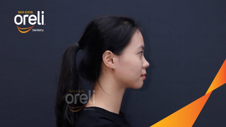 Ca niềng chỉnh hô nhô xương ổ hai hàm kết quả nụ cười đẹp sau 24 tháng tại nha khoa Oreli