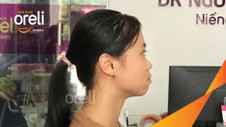 Ca niềng chỉnh hô nhô xương ổ hai hàm kết quả nụ cười đẹp sau 24 tháng tại nha khoa Oreli