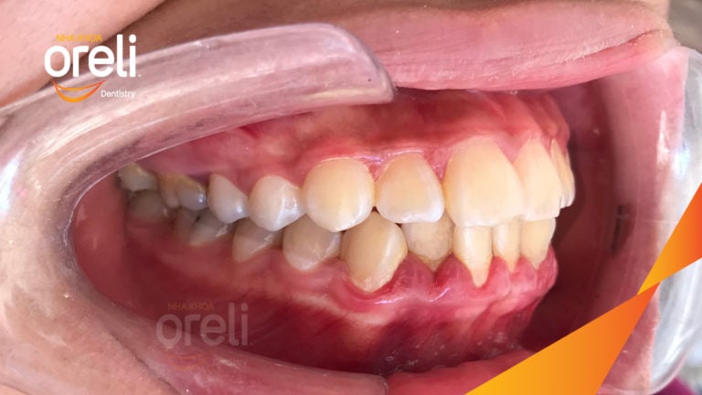 Ca niềng chỉnh hô nhô xương ổ hai hàm kết quả nụ cười đẹp sau 24 tháng tại nha khoa Oreli
