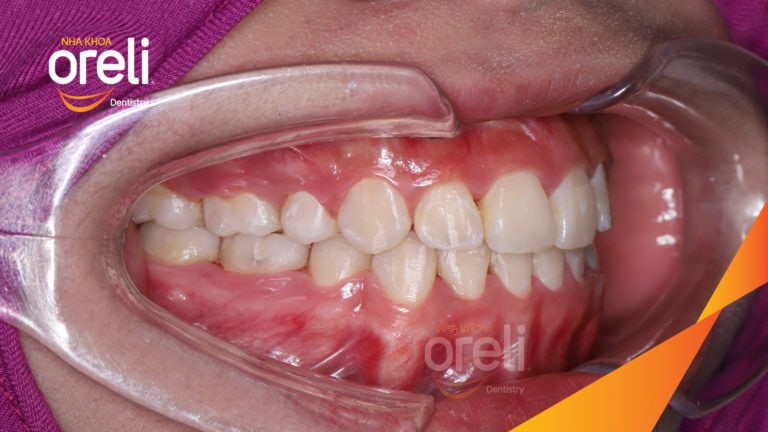 Ca niềng chỉnh hô nhô xương ổ hai hàm kết quả nụ cười đẹp sau 24 tháng tại nha khoa Oreli