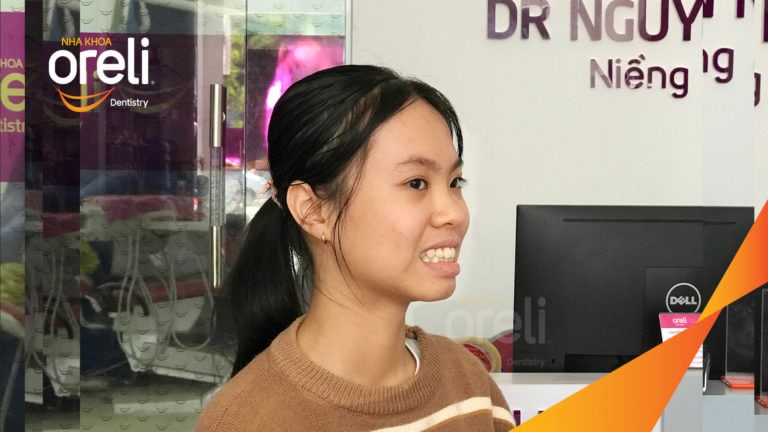 Ca niềng chỉnh hô nhô xương ổ hai hàm kết quả nụ cười đẹp sau 24 tháng tại nha khoa Oreli