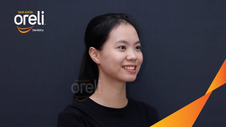 Ca niềng chỉnh hô nhô xương ổ hai hàm kết quả nụ cười đẹp sau 24 tháng tại nha khoa Oreli