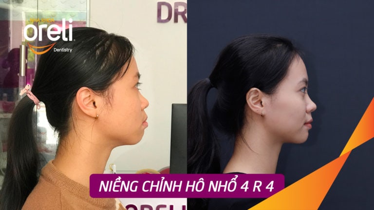 Nieng chinh ho oreli bmt