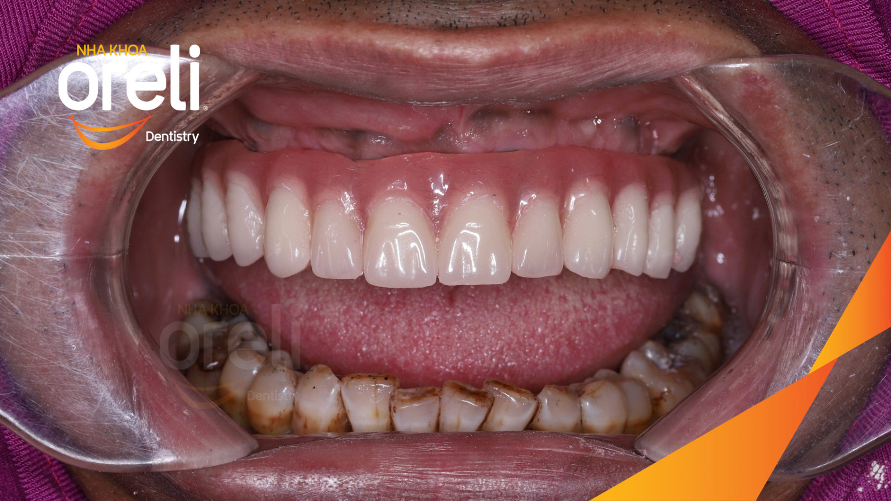  trước khi điều trị tại Oreli