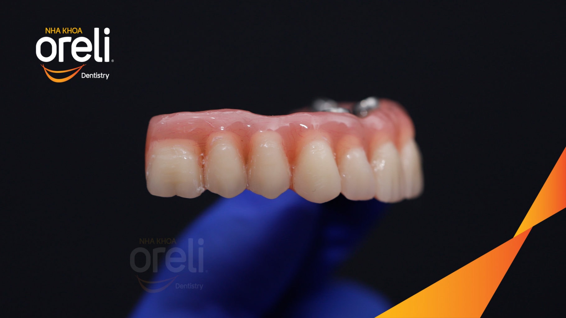 Ca trồng răng all on four hàm trên cho nụ cười đẹp ở Nha Khoa Oreli
