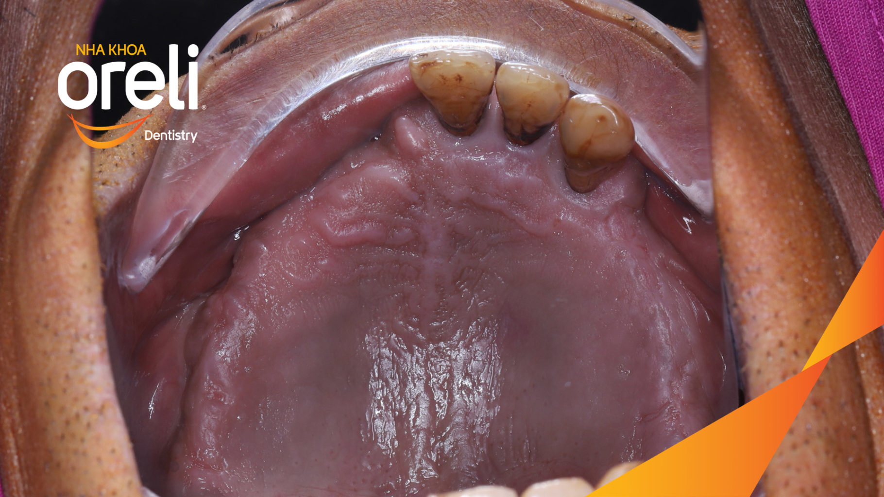 Kết quả sau :  tại Oreli