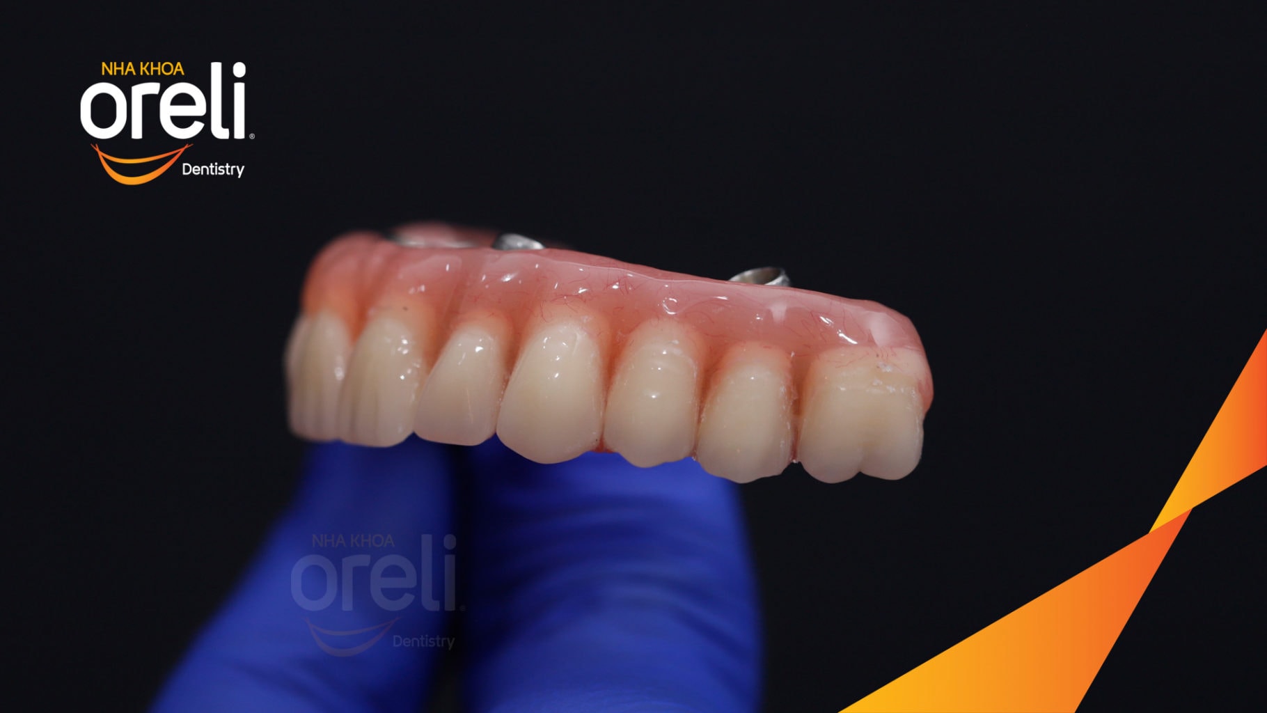 Ca trồng răng all on four hàm trên cho nụ cười đẹp ở Nha Khoa Oreli