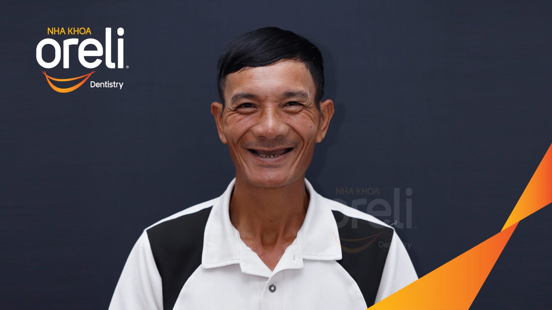 Ca trồng răng all on four hàm trên cho nụ cười đẹp ở Nha Khoa Oreli