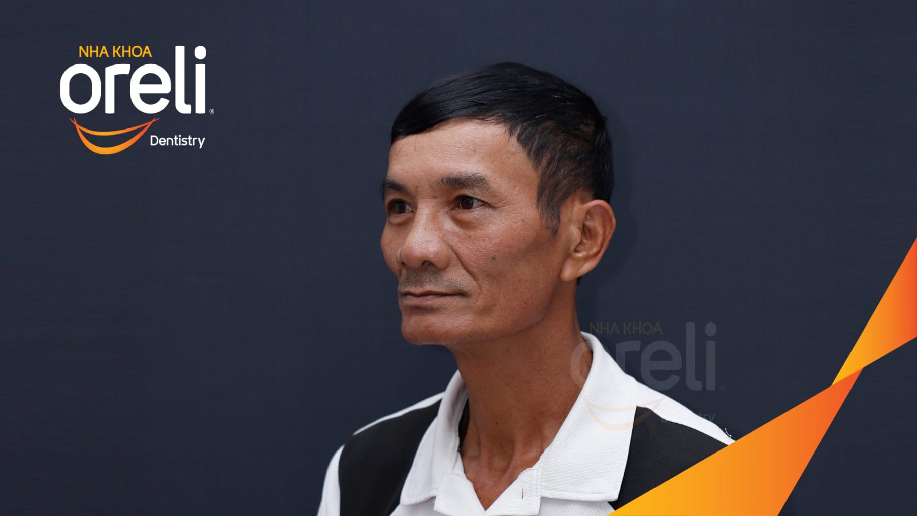 Ca trồng răng all on four hàm trên cho nụ cười đẹp ở Nha Khoa Oreli