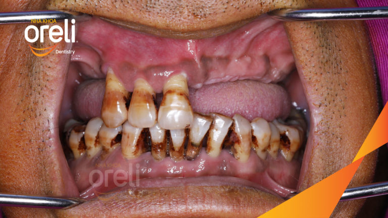 Ca trồng răng all on four hàm trên cho nụ cười đẹp ở Nha Khoa Oreli