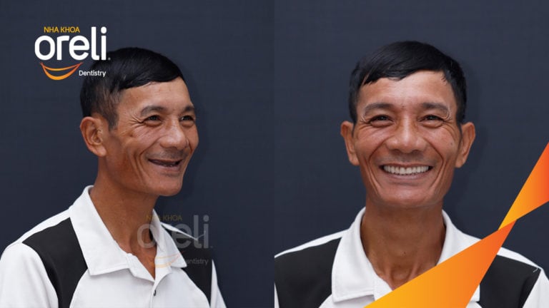 cay ghep rang toan ham Oreli