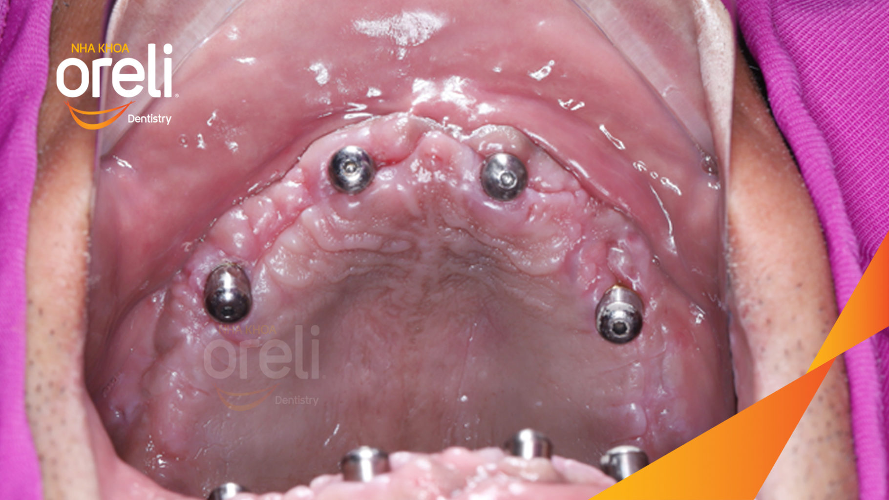 Kết quả đạt được sau  -  tại Oreli