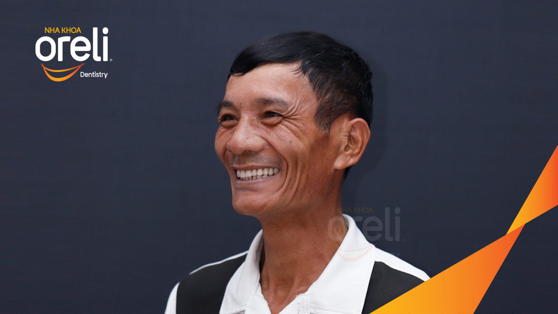 Ca trồng răng all on four hàm trên cho nụ cười đẹp ở Nha Khoa Oreli