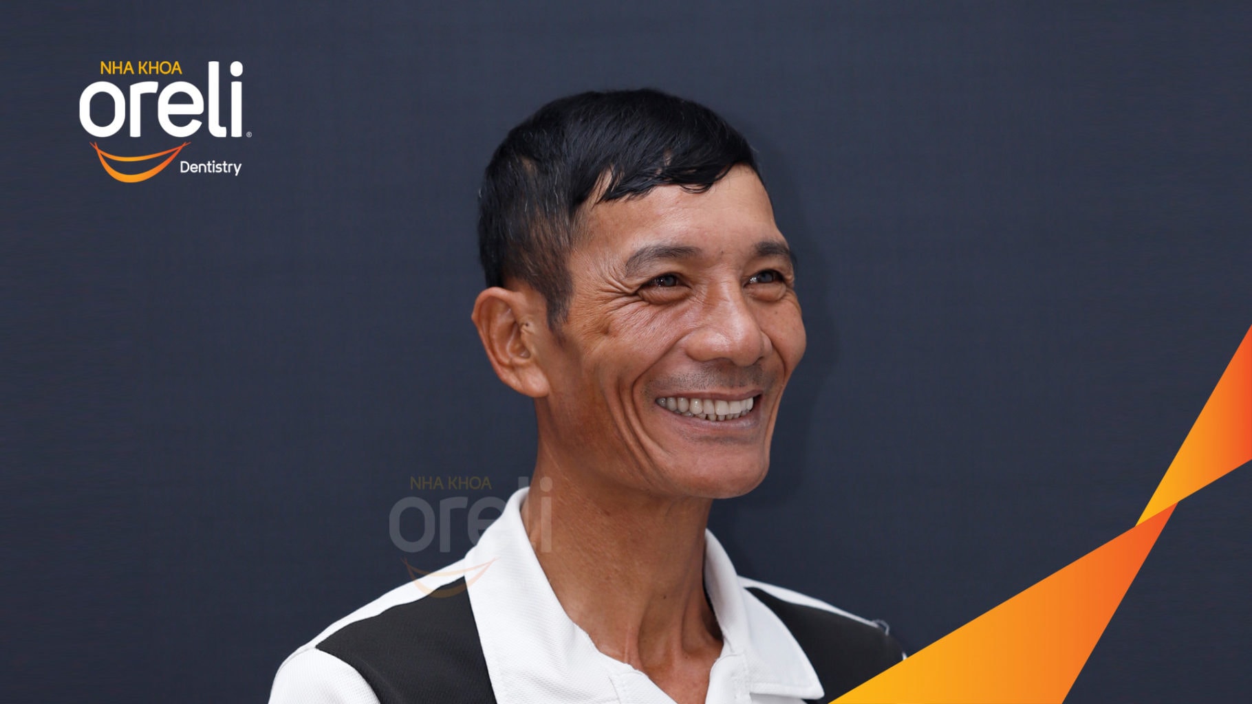 Ca trồng răng all on four hàm trên cho nụ cười đẹp ở Nha Khoa Oreli