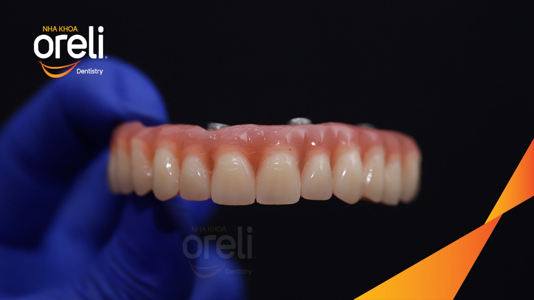 Ca trồng răng all on four hàm trên cho nụ cười đẹp ở Nha Khoa Oreli