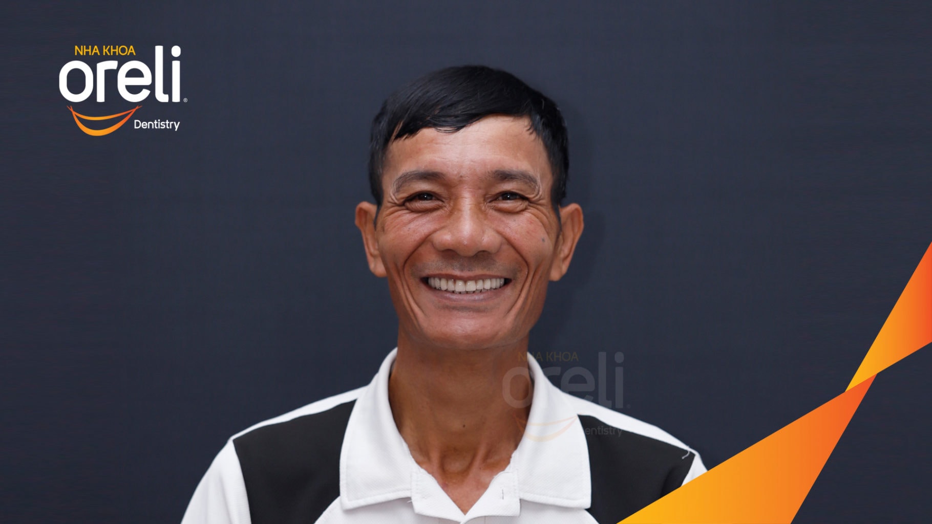 Ca trồng răng all on four hàm trên cho nụ cười đẹp ở Nha Khoa Oreli