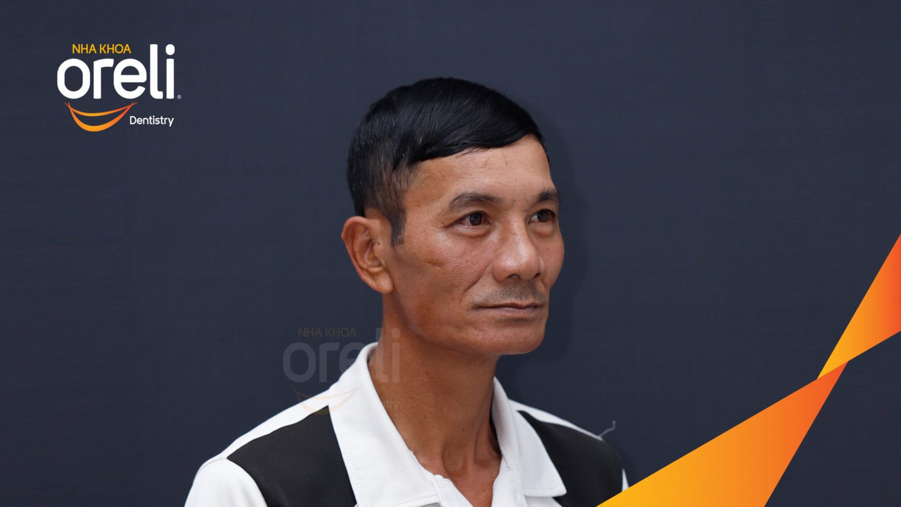 Ca trồng răng all on four hàm trên cho nụ cười đẹp ở Nha Khoa Oreli