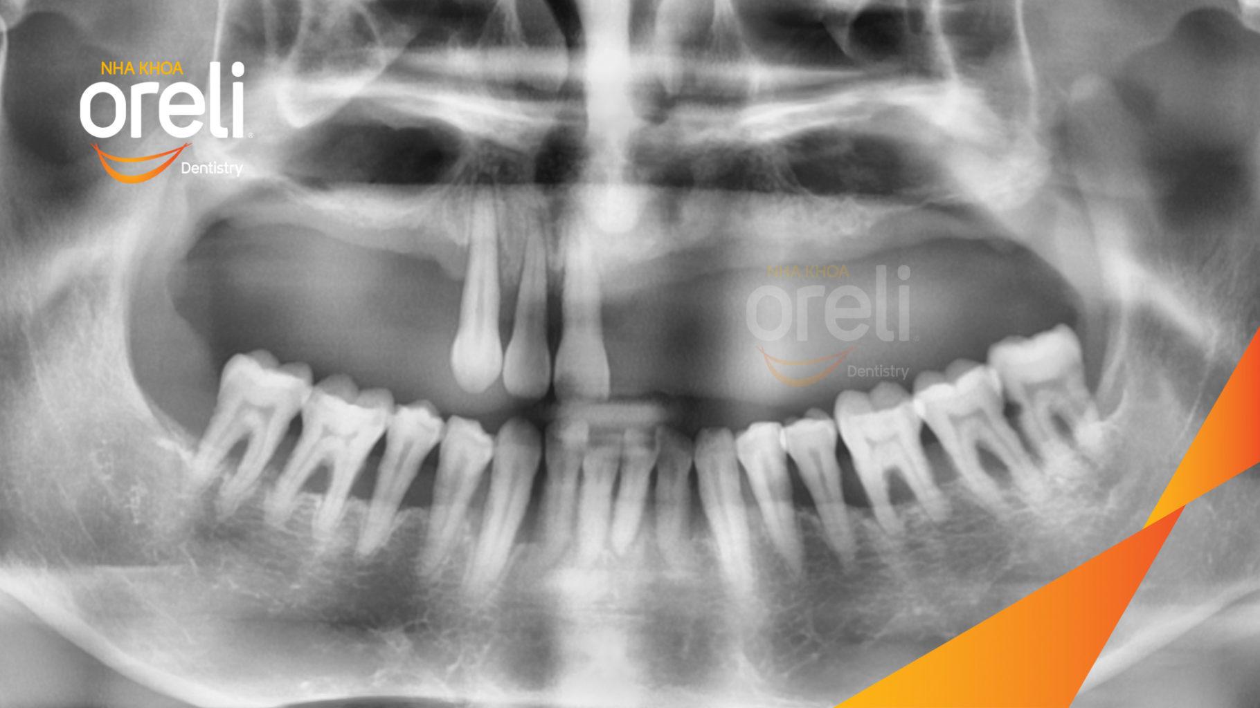 Trước điều trị:  tại Oreli