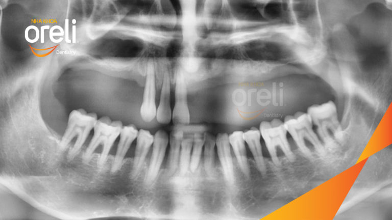 Ca trồng răng all on four hàm trên cho nụ cười đẹp ở Nha Khoa Oreli