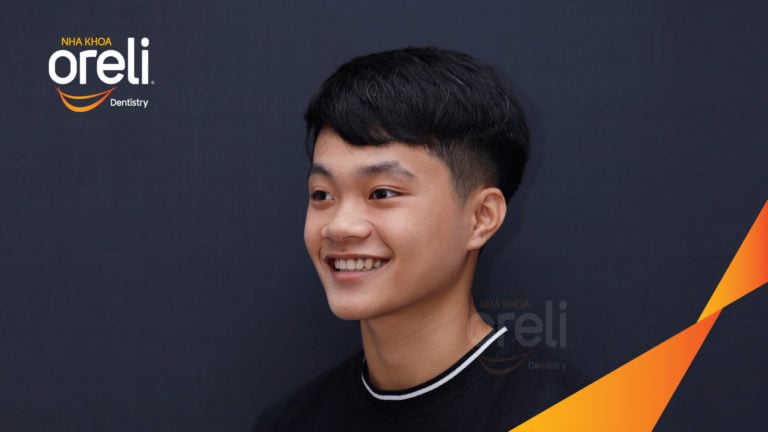 Niềng răng hô nhổ 4 răng số 4 – Trước & sau thực tế tại Buôn Ma Thuột