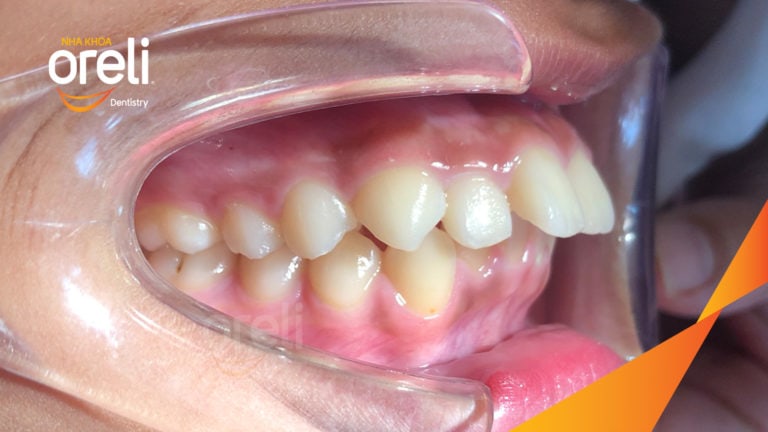 Niềng răng hô nhổ 4 răng số 4 – Trước & sau thực tế tại Buôn Ma Thuột