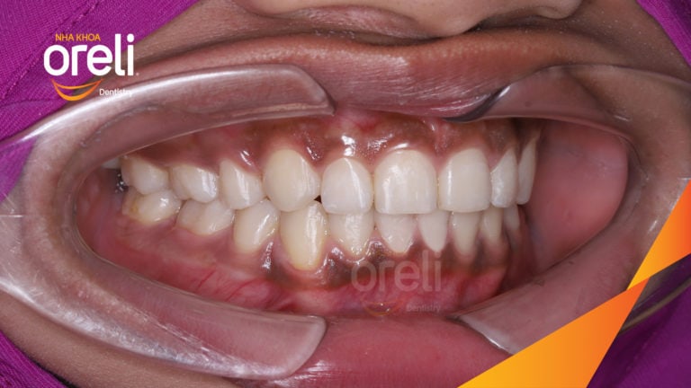 Niềng răng hô nhổ 4 răng số 4 – Trước & sau thực tế tại Buôn Ma Thuột