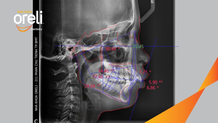 Niềng răng hô nhổ 4 răng số 4 – Trước & sau thực tế tại Buôn Ma Thuột