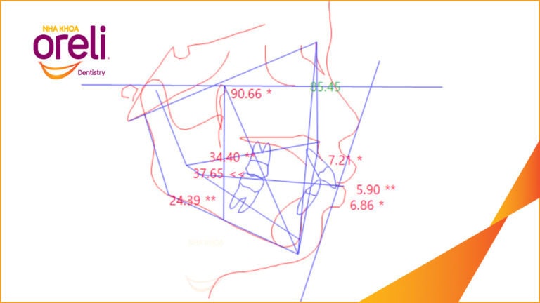 Niềng răng hô nhổ 4 răng số 4 – Trước & sau thực tế tại Buôn Ma Thuột