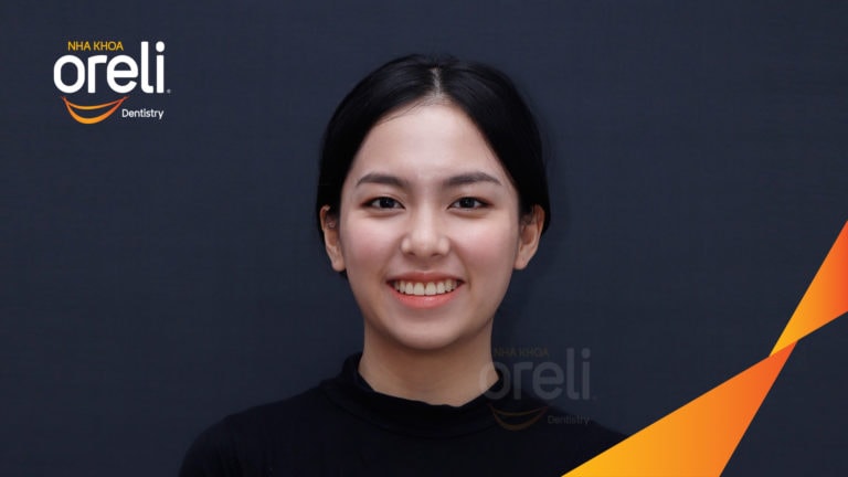 Niềng răng hô nặng phải nhổ 4 răng số 4 – Hành trình tại Oreli