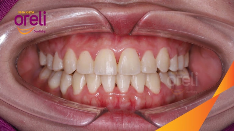 Niềng răng hô nặng phải nhổ 4 răng số 4 – Hành trình tại Oreli