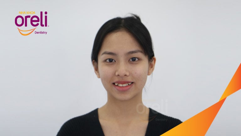 Niềng răng hô nặng phải nhổ 4 răng số 4 – Hành trình tại Oreli