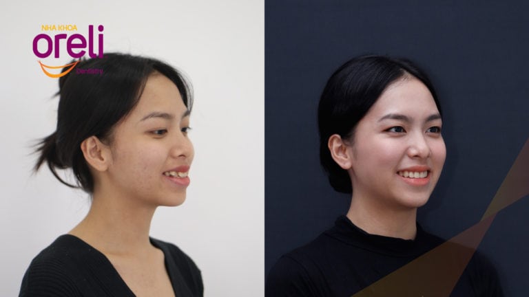 nieng rang ho uy tin nha khoa oreli