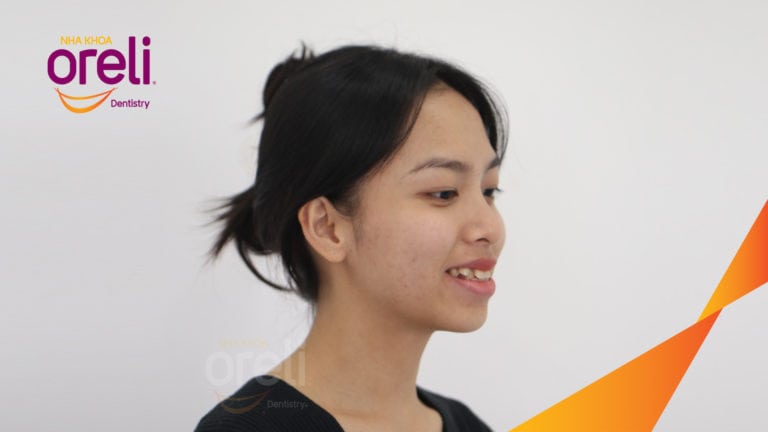 Niềng răng hô nặng phải nhổ 4 răng số 4 – Hành trình tại Oreli