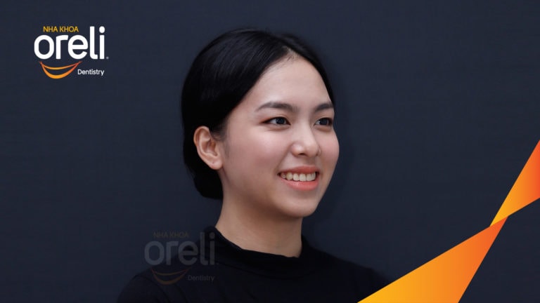 Niềng răng hô nặng phải nhổ 4 răng số 4 – Hành trình tại Oreli
