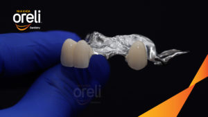 Răng giả tháo lắp hàm khung