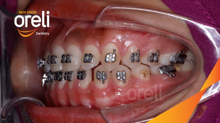 Ca niềng chỉnh cười hở nướu khe thưa kết quả sau 2 năm tại nha khoa Oreli
