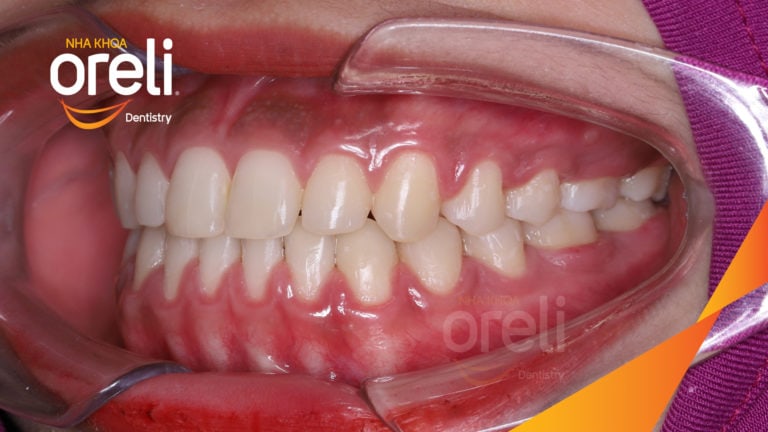 Ca niềng chỉnh cười hở nướu khe thưa kết quả sau 2 năm tại nha khoa Oreli